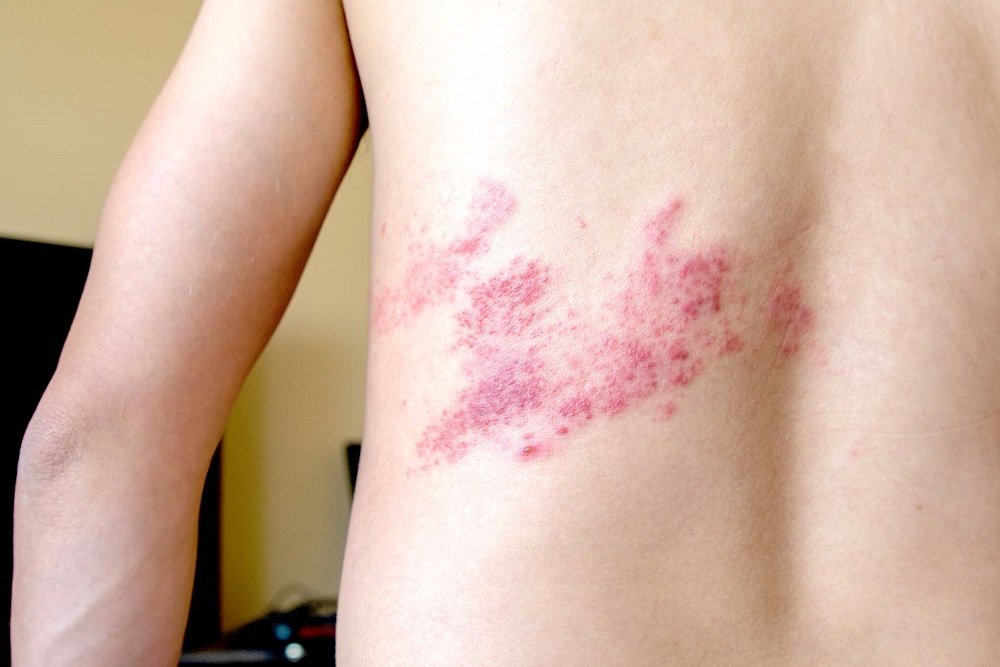 Does shingles cause dementia?