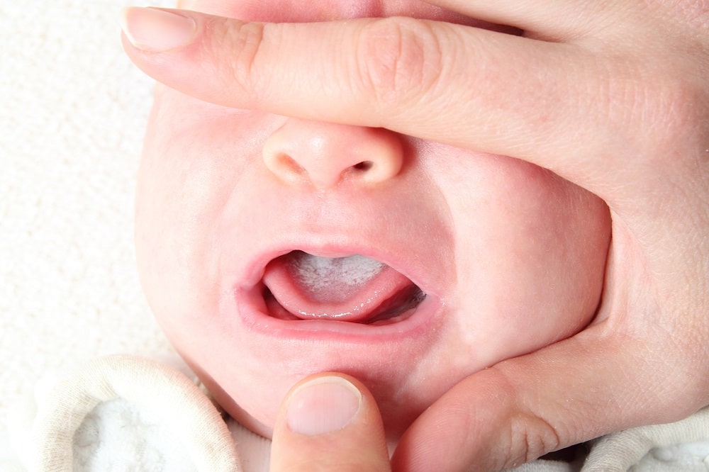 Oral,Thrush,Of,A,Newborn,Baby