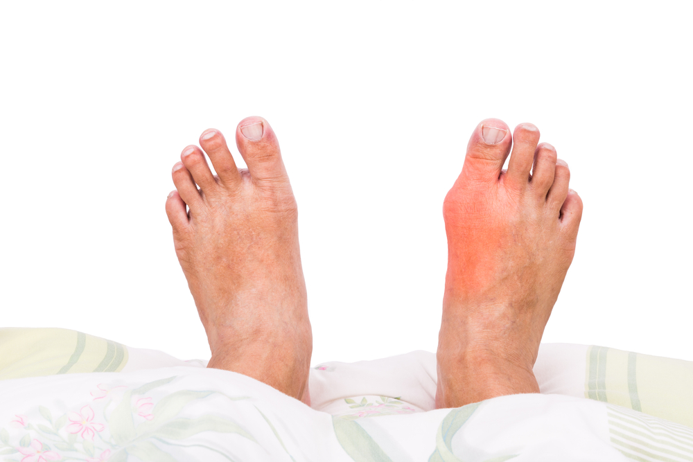 Tart cherries to provide Painful Gout relief